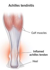 Achilles-Tendinopathy.jpg