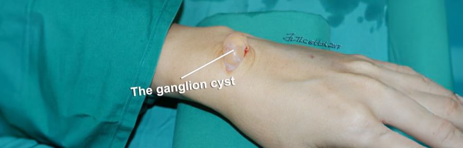 Ganglion-Cyst-1-min.jpg