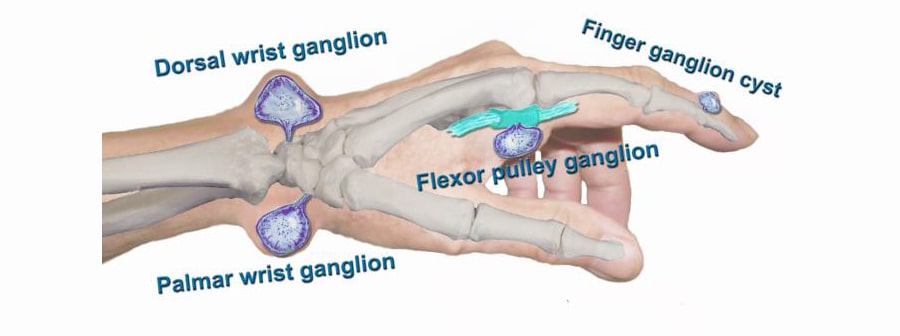 Ganglion-Cyst-2-min.jpg